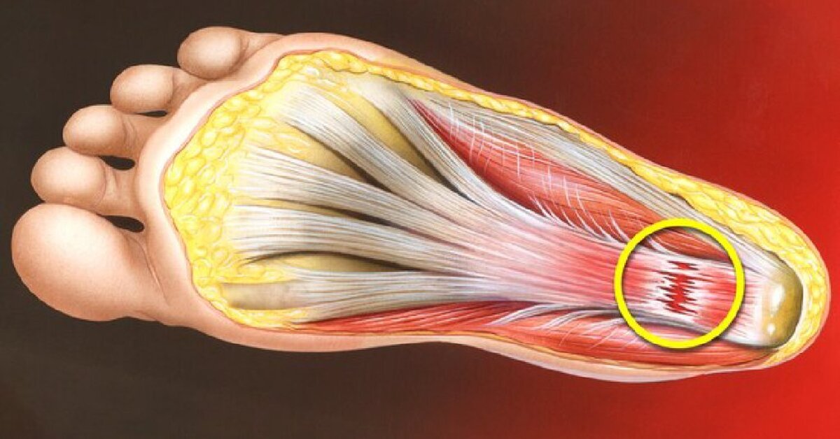 Плантарный фасциит стопы гимнастика